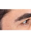 After Hair Transplant &nbsp;Eyebrows